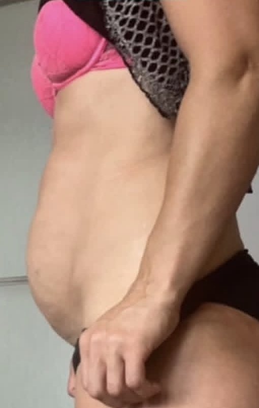 Client side profile of stomach after four sessions
