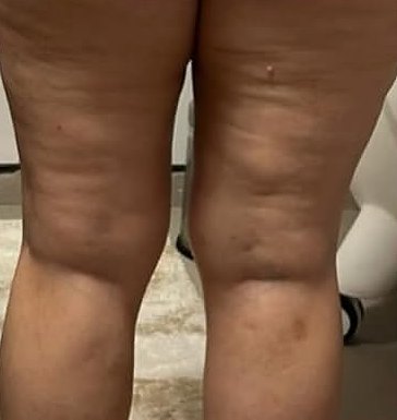 Back of thighs before treatment
