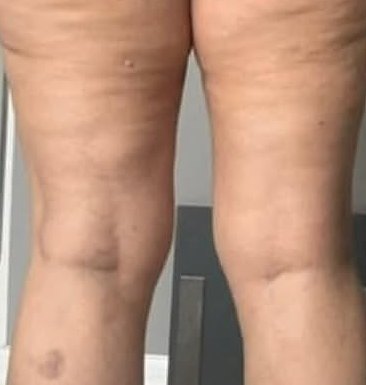 Back of thighs after six sessions