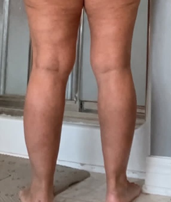 Back of legs after treatment