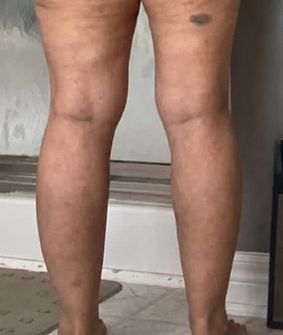 Back of legs before treatment
