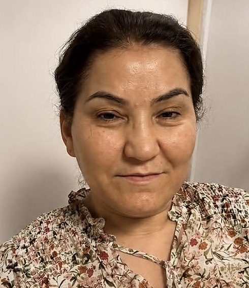 Client face before microcurrent facial